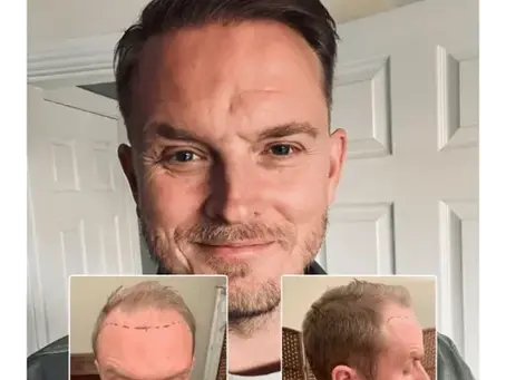 Hair Transplant Essex: Advanced Solutions for Natural and Lasting Hair Restoration