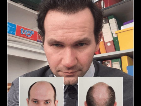 Hair Transplant Essex: A Trusted Solution for Natural Hair Restoration