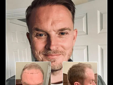 Hair Transplant Kent: Expert Solutions for Natural and Long-Lasting Hair Restoration