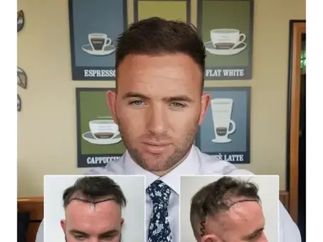 Hair Loss Clinic Essex: Professional Solutions for Hair Restoration and Confidence