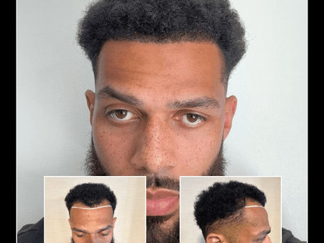 Hair Transplant Tunbridge Wells: Advanced Solutions for Natural Hair Restoration