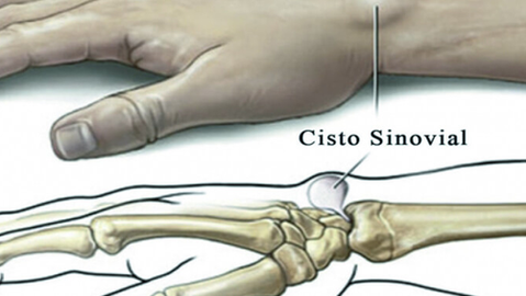 Cisto Sinovial: O Caroço Misterioso Que Pode Estar Acabando Com Seus Movimentos – E Como Resolver Isso!