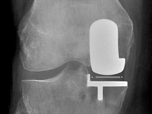 Knee arthroplasty - rehabilitation protocol