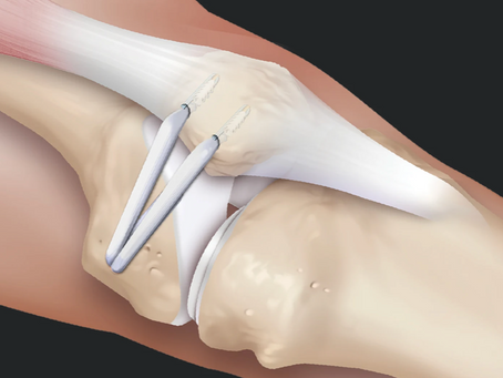When surgery needed for acute patella dislocations?