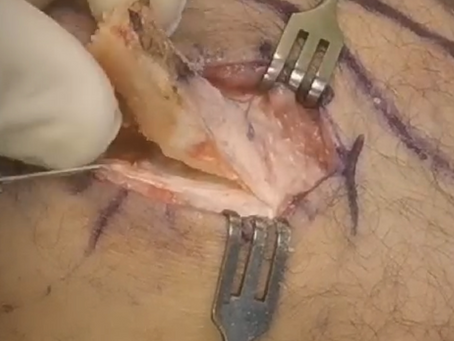 Choose the best graft for your ACL tear