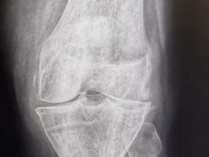 How to know when it is time for knee replacement surgery