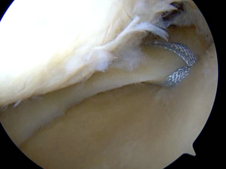 Meniscus Root Repair - how it is done and how long is the healing process?