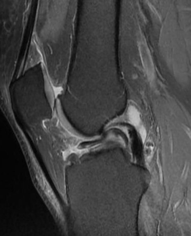 MRI scan with bucket handle tear shown as 'double PCL sign'