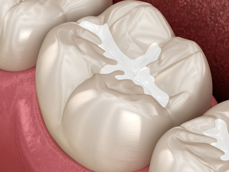 Dental Sealants Can Help Cavity-Prone Teeth! Learn More From Your Family Dentist in Irving, Texas