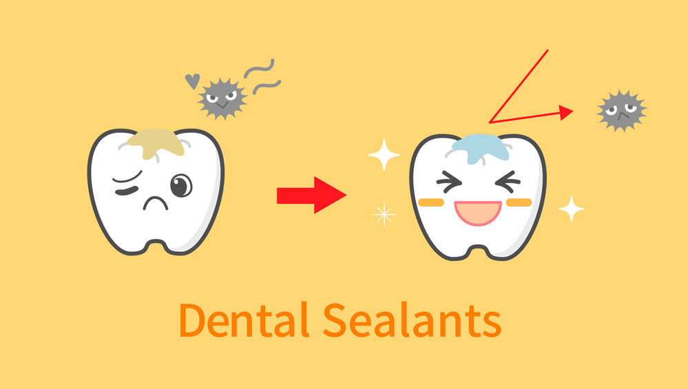Dental Sealants Can Help CavityProne Teeth! Learn More From Your
