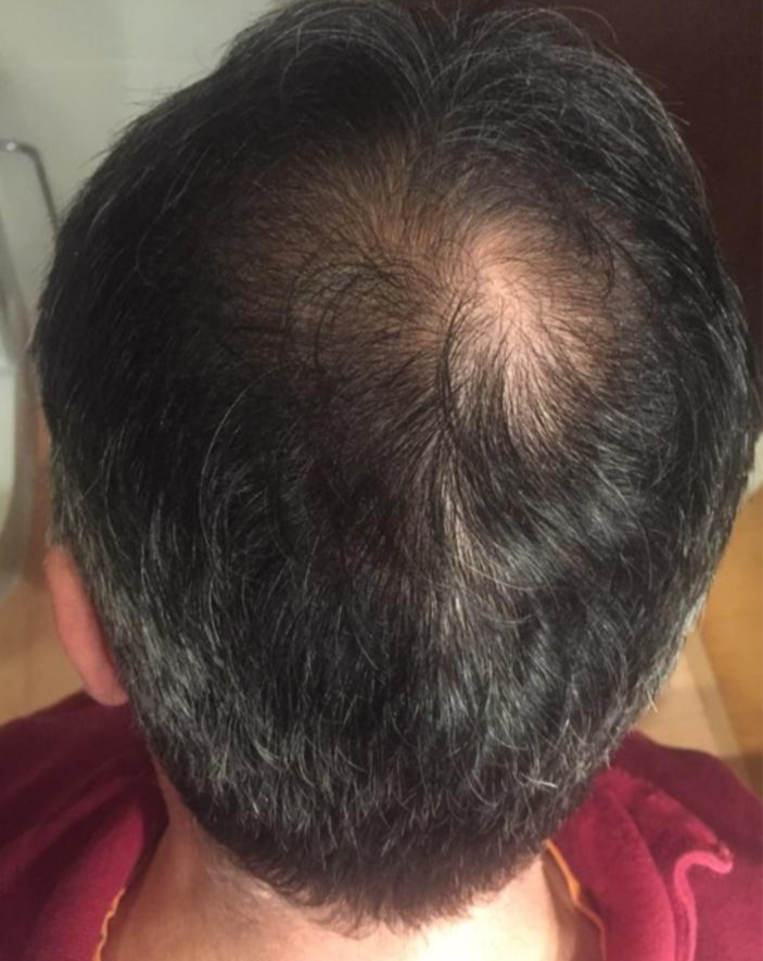 Before, After Follicure+ Therapy
