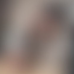 Botox for Migraines: how it works and who should consider it