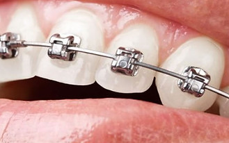 aparelho-ortodontico-metalico-autoligado-francisco-stroparo-ortodontia.jpg