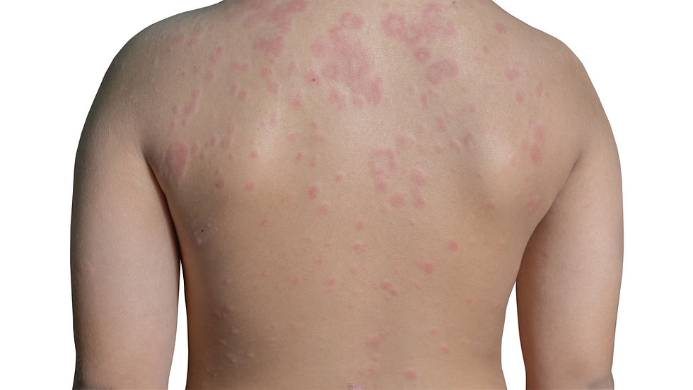 Young child with hives