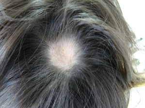 Alopecia Areata