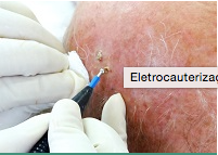 Eletrocauterização