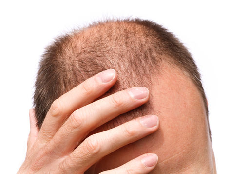 Mesoterapia Capilar