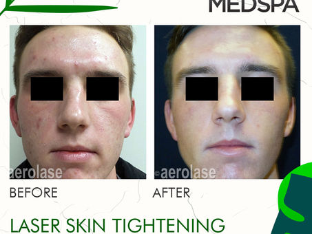 LASER SKIN REJUVENATION & TIGHTENING AT MEDICAL SPA. MAKE YOUR SKIN GLOW