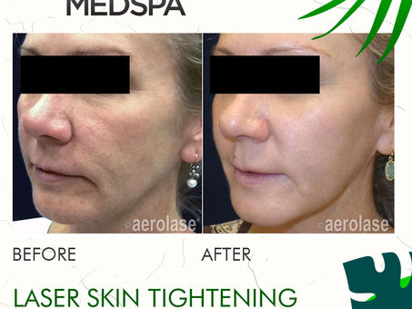 LASER SKIN REJUVENATION & TIGHTENING AT MEDICAL SPA
