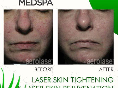 LASER SKIN REJUVENATION & TIGHTENING WITH AEROLASE NEO LASER