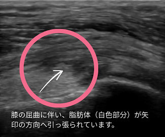 白色の脂肪体が矢印の方向へ引っ張られている_edited.jpg