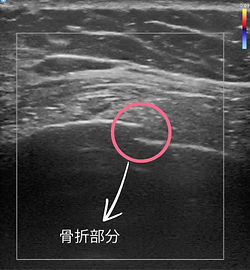 肋骨骨折 エコー静止画