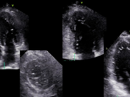 Ejemplos de trabeculación excesiva del ventrículo izquierdo
