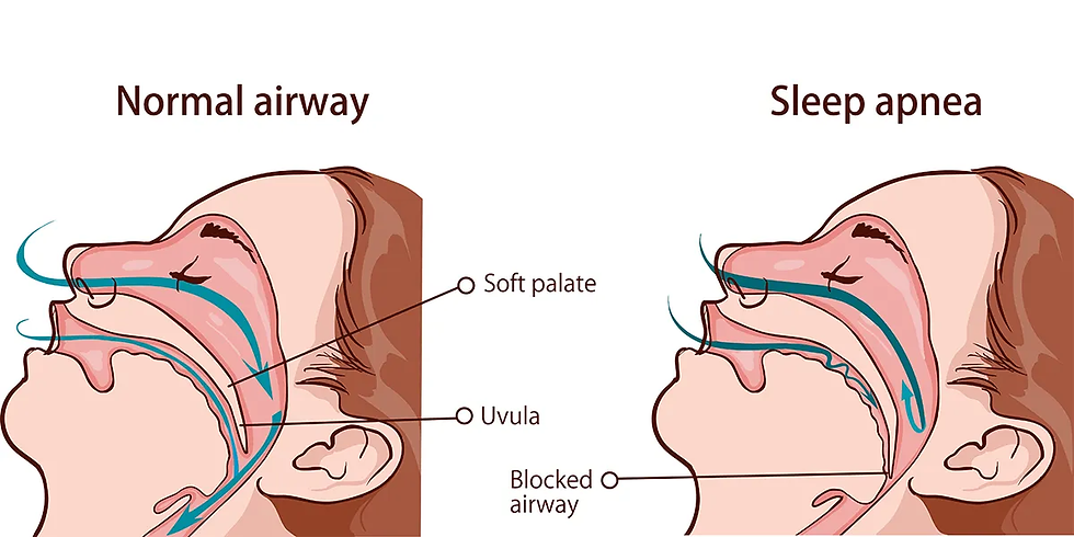 Sleep apnea vs normal airway