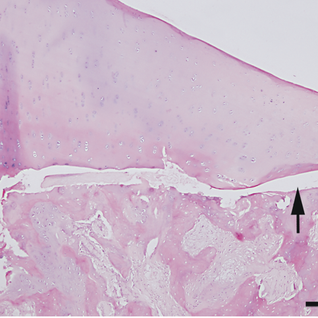 Osteochondritis dissecans i kneet