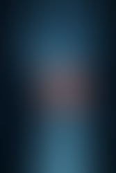 Scapholunate Dissociation