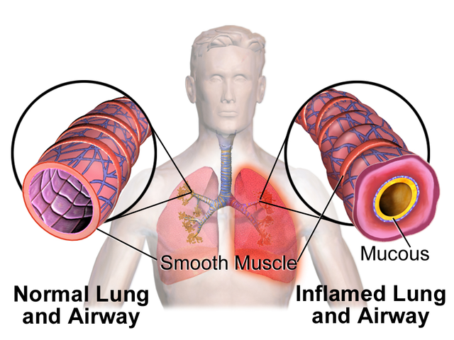 Image: “Asthma – lungs with normal vs inflamed airway” by BruceBlaus / Blausen.com staff, from Medical gallery of Blausen Medical 2014, via Wikimedia Commons (https://commons.wikimedia.org/wiki/File:Blausen_0620_Lungs_NormalvsInflamedAirway.png), licensed under Creative Commons Attribution 3.0 Unported (CC BY 3.0, https://creativecommons.org/licenses/by/3.0/).