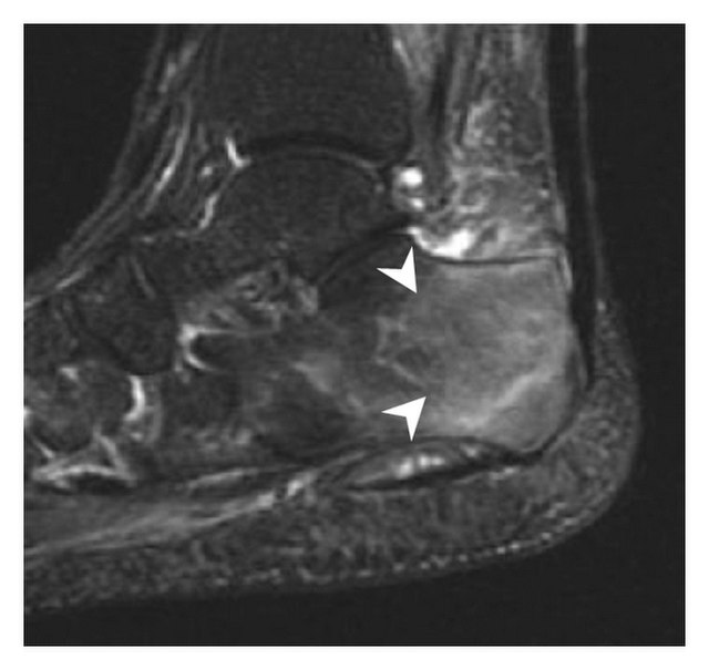 (2013). "Radiographically Occult and Subtle Fractures: A Pictorial Review". Radiology Research and Practice 2013: 1–10. DOI:10.1155/2013/370169. ISSN 2090-1941. CC-BY 3.0 Mohamed Jarraya, Daichi Hayashi, Frank W. Roemer, Michel D. Crema, Luis Diaz, Jane Conlin, Monica D. Marra, Nabil Jomaah and Ali Guermazi