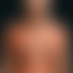 Revmatoid Polymyalgi