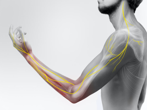 Upper Extremity Functional Index (UEFI)