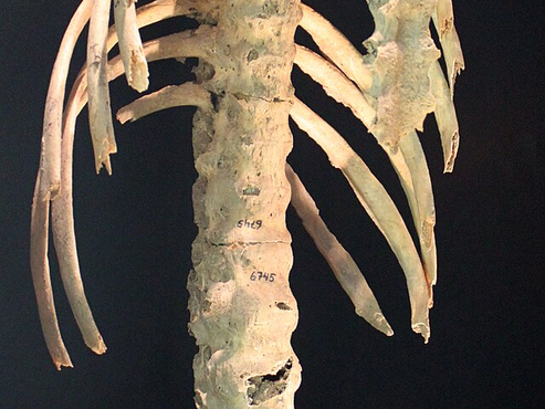 Ankolyserende Spondylitt (axial spondyloartritt)