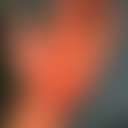 Rehabilitation of Hand Burns