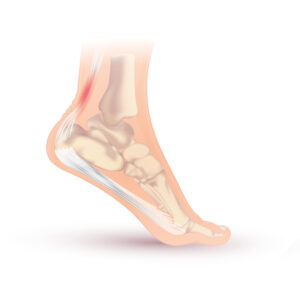 Achilles tendinopati