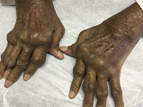 Revmatisk artritt i hånden