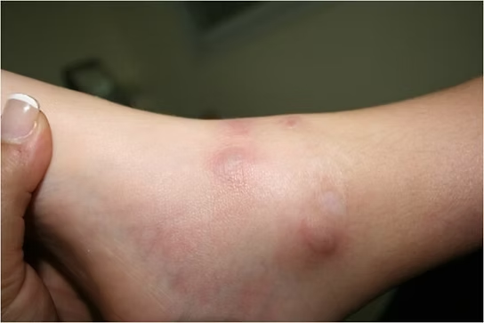 Polyarteritis Nodosa 