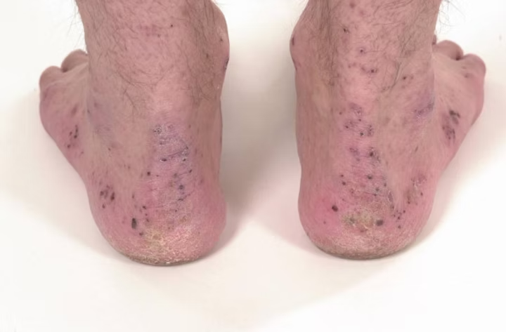 Image: “Crusts around the ankles and feet in a patient with Crohn's disease and bowel-associated dermatosis-arthritis syndrome (BADAS)” by Dayavathi Ashok and Patrick Kiely, from Bowel associated dermatosis – arthritis syndrome: a case report, J Med Case Reports (2007), via Wikimedia Commons (https://commons.wikimedia.org/wiki/File:BADAS_Crohn_2.jpg), licensed under Creative Commons Attribution 2.0 Generic (CC BY 2.0, https://creativecommons.org/licenses/by/2.0/).