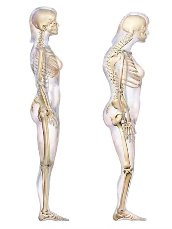 Image: Medical illustration showing degenerative kyphosis of the spine in a standing human figure, with increased thoracic curvature and forward head/rounded shoulder posture. Created by BruceBlaus, first published 19 June 2017 as “Kyphosis Degenerative.png.” Source: Wikimedia Commons (Creative Commons Attribution-ShareAlike 4.0 International license).