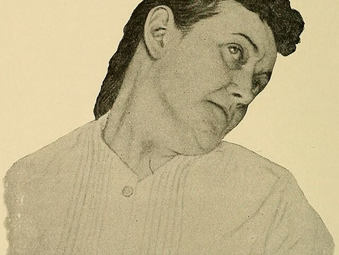 Adult-Onset Torticollis (Cervical Dystonia / Spasmodic Torticollis)