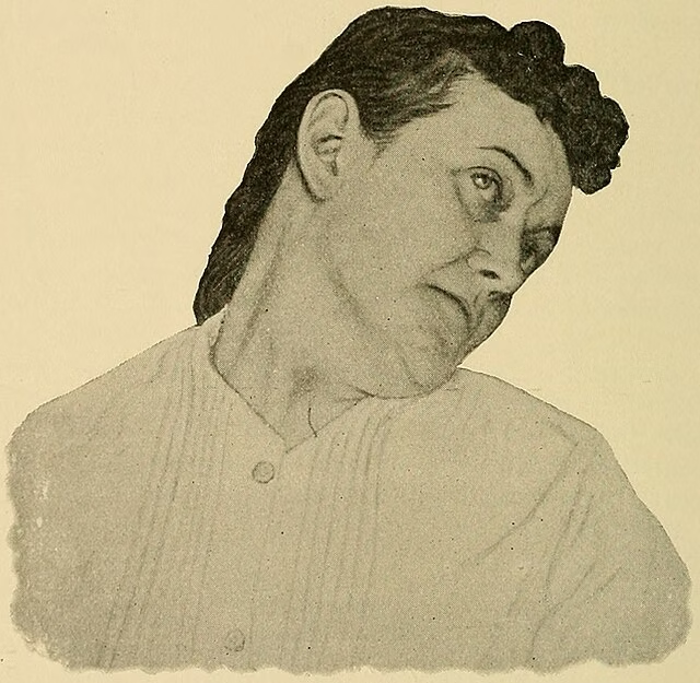 Image: Illustration of a patient with hysterical torticollis, reproduced from A System of Practical Medicine by American Authors, Vol. 4 (1897). Original work by Alfred Loomis and William Thompson, with the scan accessed via Wikimedia Commons (file name: Hysterical_torticollis.jpg). First published in 1897, so the image is in the public domain (published before 1930 in the United States).