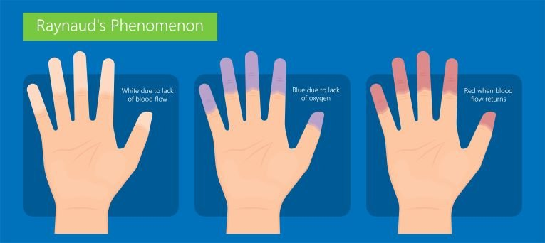 Raynaud’s Phenomenon