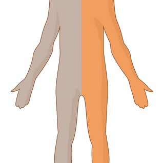 Hemiplegisk skuldersubluksasjon