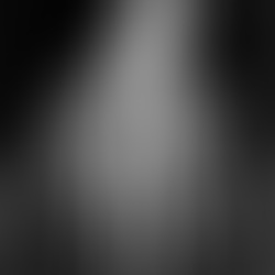 Ulnar Impaction Syndrome