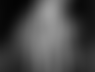 Ulnar Impaction Syndrome