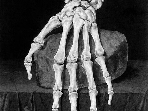 Ulnar Impaction Syndrome