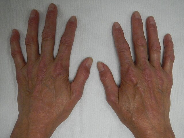 “CREST syndrome (calcinosis and sclerodactyly)”. Image: James Heilman (own work). Original file: “CREST1.JPG” on Wikimedia Commons. License: Creative Commons Attribution-ShareAlike 4.0 International (CC BY-SA 4.0).