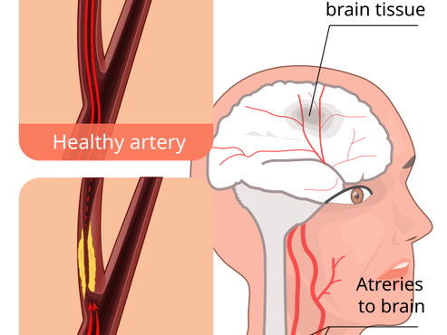 "Mini slag": Transitorisk iskemisk anfall (TIA)